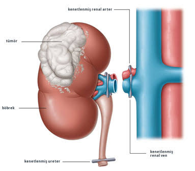 Transurethral resection of the prostate TURP